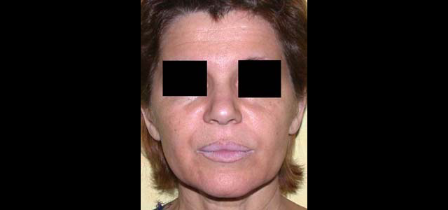 chirurgie-esthetique-interventions-visage-liftings