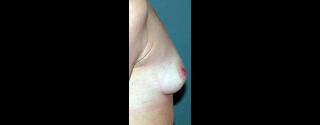 chirurgie-esthetique-interventions-seins-augmentations-mammaires
