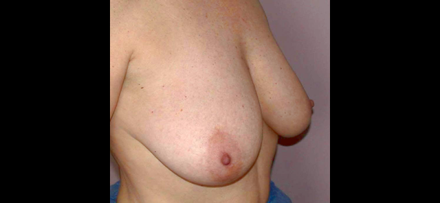 chirurgie-esthetique-interventions-seins-ptoses-mammaires-sans-implant