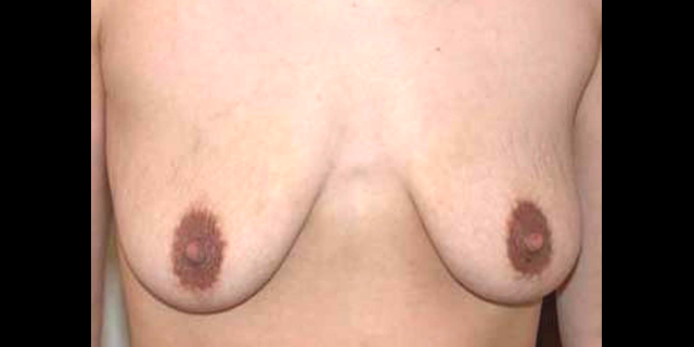 chirurgie-esthetique-interventions-seins-correction-ptose-avec-implants