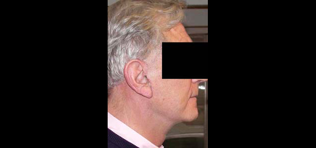 chirurgie-esthetique-interventions-visage-liftings