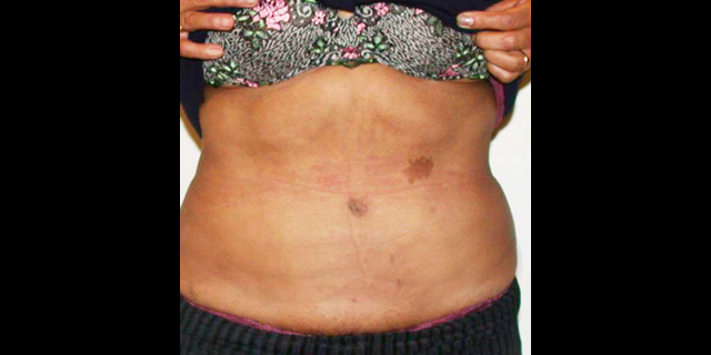 chirurgie-esthetique-interventions-abdomens-abdominoplasties