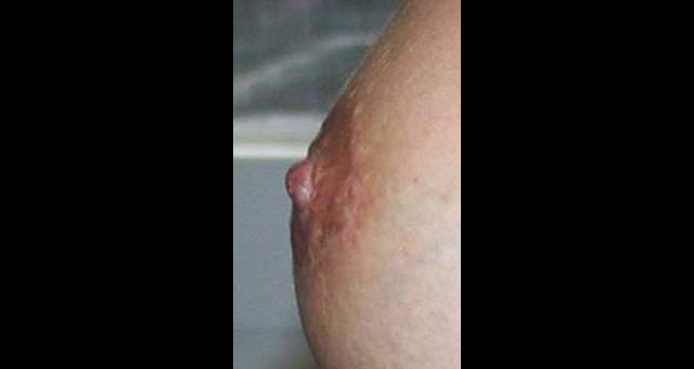 chirurgie-esthetique-interventions-seins-reduction-mamelon