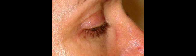 chirurgie-esthetique-interventions-paupieres-blépharoplasties