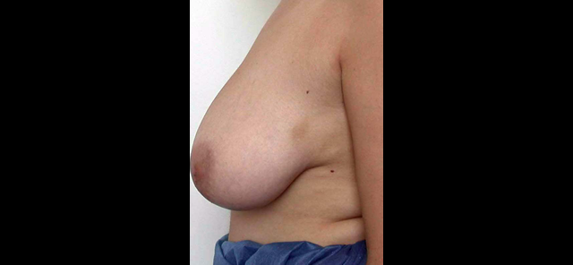 chirurgie-esthetique-interventions-seins-reductions-mammaires