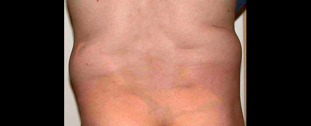 chirurgie-esthetique-interventions-lipoaspirations-liposuccions