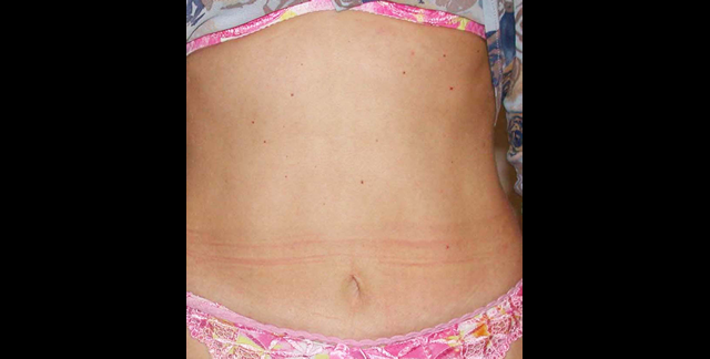 chirurgie-esthetique-interventions-abdomens-abdominoplasties