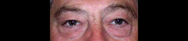 chirurgie-esthetique-interventions-paupieres-blépharoplasties