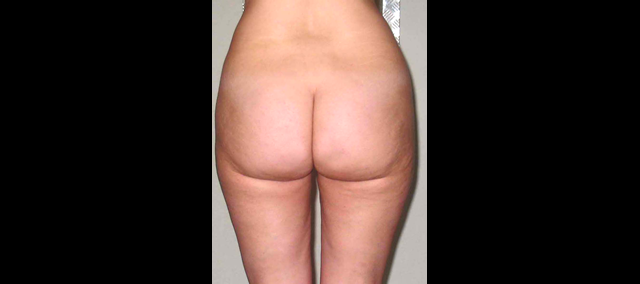 chirurgie-esthetique-interventions-lipoaspirations-liposuccions