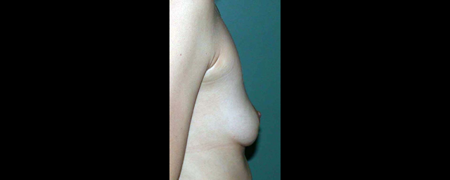 chirurgie-esthetique-interventions-seins-augmentations-mammaires