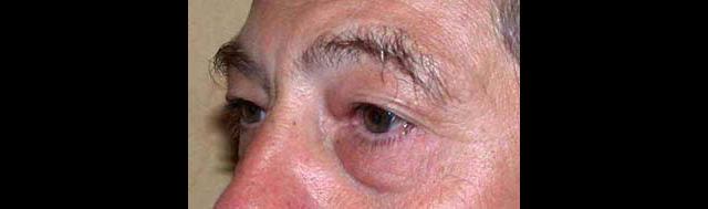 chirurgie-esthetique-interventions-paupieres-blépharoplasties