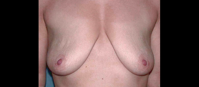 chirurgie-esthetique-interventions-seins-ptoses-mammaires-sans-implant