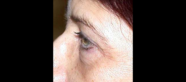 chirurgie-esthetique-interventions-paupieres-blépharoplasties