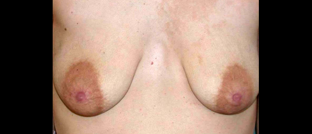 chirurgie-esthetique-interventions-seins-correction-ptose-avec-implants