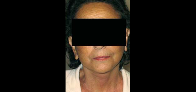 chirurgie-esthetique-interventions-visage-liftings
