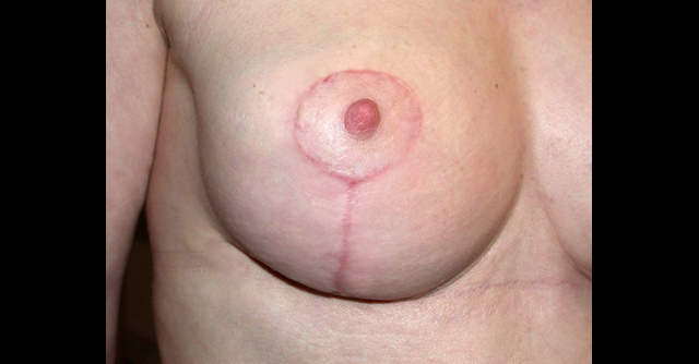 chirurgie-esthetique-interventions-seins-ptoses-mammaires-sans-implant