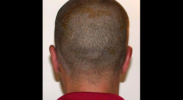 chirurgie-esthetique-pierre-nahon-interventions-oreilles-09