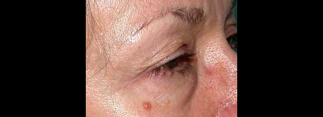 chirurgie-esthetique-interventions-paupieres-blépharoplasties