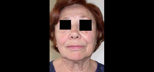 chirurgie-esthetique-interventions-visage-liftings