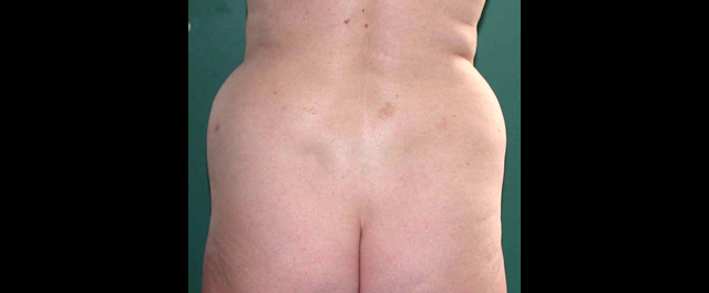 chirurgie-esthetique-interventions-lipoaspirations-liposuccions