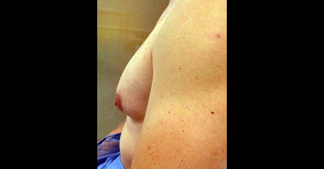 chirurgie-esthetique-interventions-gynecomasties
