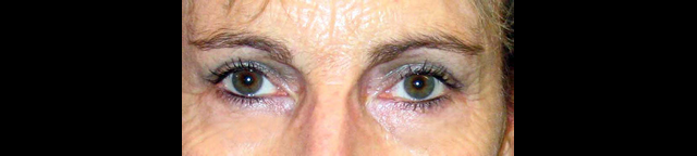 chirurgie-esthetique-interventions-paupieres-blépharoplasties