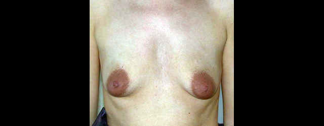 chirurgie-esthetique-interventions-seins—réduction-areoles