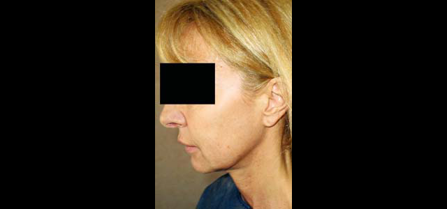 chirurgie-esthetique-interventions-visage-liftings