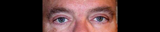 chirurgie-esthetique-interventions-paupieres-blépharoplasties