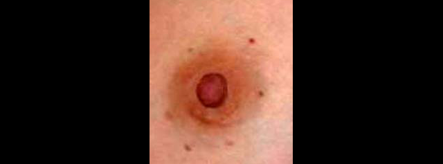 chirurgie-esthetique-interventions-seins-reduction-mamelon