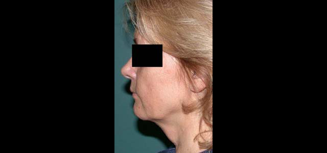 chirurgie-esthetique-interventions-visage-liftings