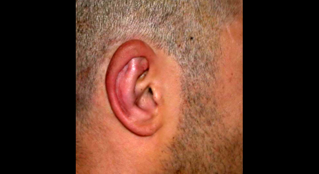 chirurgie-esthetique-pierre-nahon-interventions-oreilles-11