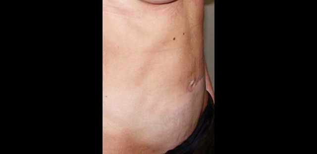 chirurgie-esthetique-interventions-abdomens-abdominoplasties