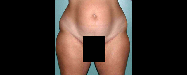 chirurgie-esthetique-interventions-lipoaspirations-liposuccions