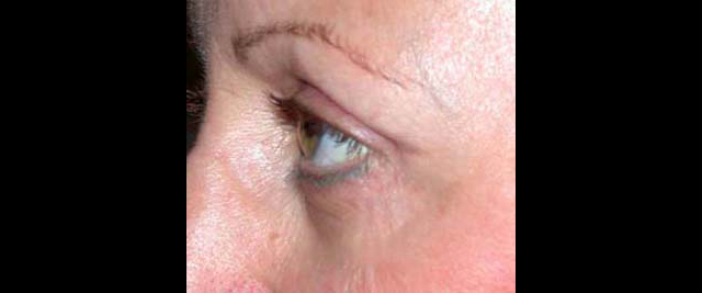 chirurgie-esthetique-interventions-paupieres-blépharoplasties