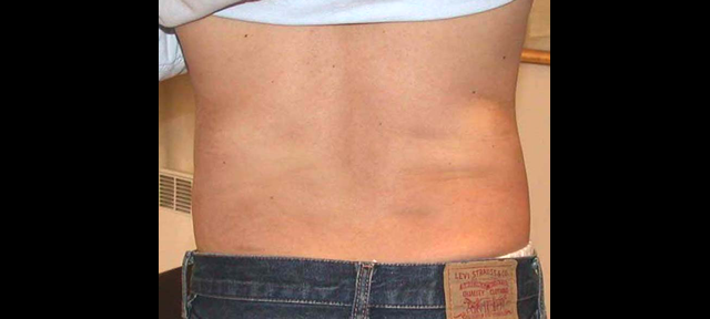 chirurgie-esthetique-interventions-lipoaspirations-liposuccions
