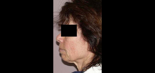 chirurgie-esthetique-interventions-visage-liftings