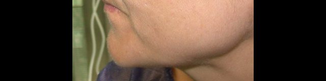 même patiente de profil avant