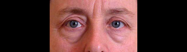 chirurgie-esthetique-interventions-paupieres-blépharoplasties