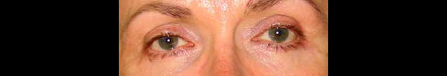 chirurgie-esthetique-interventions-paupieres-blépharoplasties