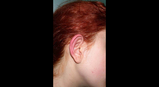 chirurgie-esthetique-pierre-nahon-interventions-oreilles-02