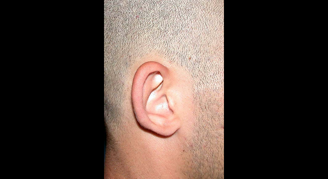 chirurgie-esthetique-pierre-nahon-interventions-oreilles-10