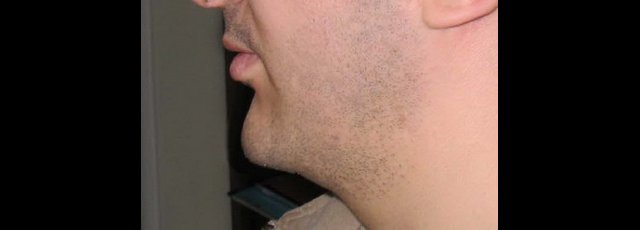 avancée du menton pas pose d'implant