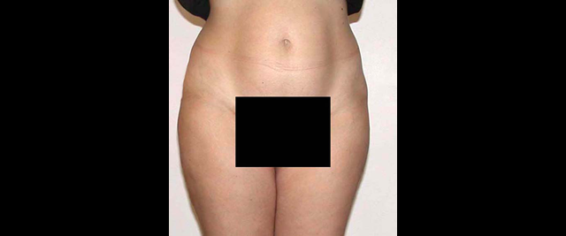 chirurgie-esthetique-interventions-lipoaspirations-liposuccions
