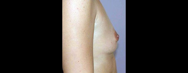 chirurgie-esthetique-interventions-seins-augmentations-mammaires