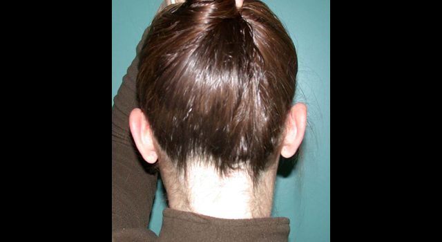 chirurgie-esthetique-pierre-nahon-interventions-oreilles-04