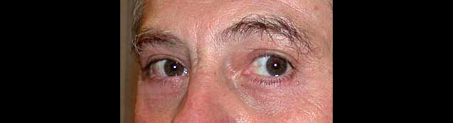 chirurgie-esthetique-interventions-paupieres-blépharoplasties