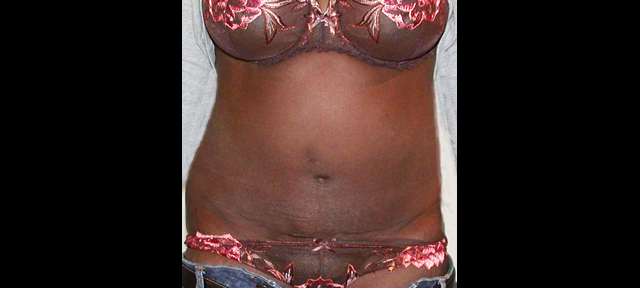 chirurgie-esthetique-interventions-abdomens-abdominoplasties