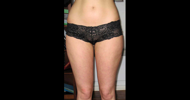 chirurgie-esthetique-interventions-lipoaspirations-liposuccions