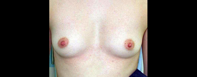 chirurgie-esthetique-interventions-seins-augmentations-mammaires